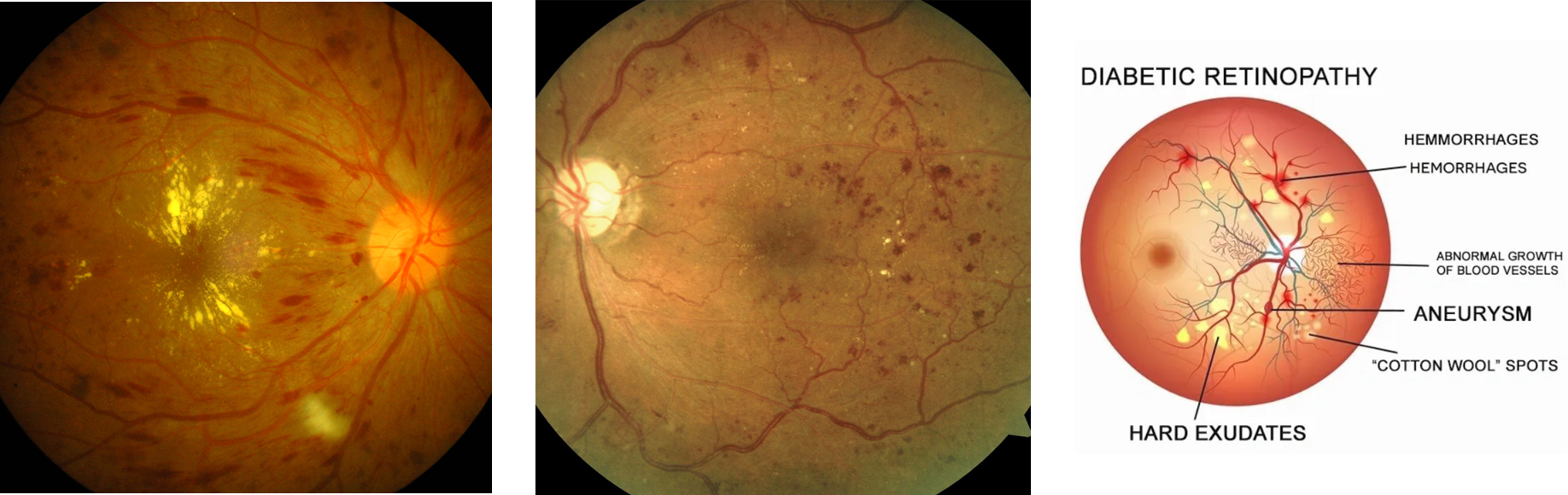 photo - diabetic retinopathy